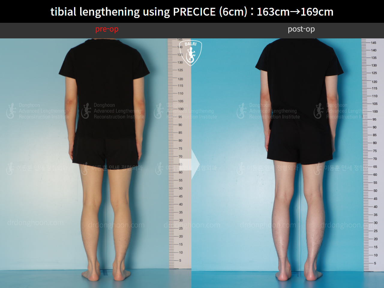 Before and after cll precice, case 16061529, image 4, Dr. Donghoon institute (DALRI)