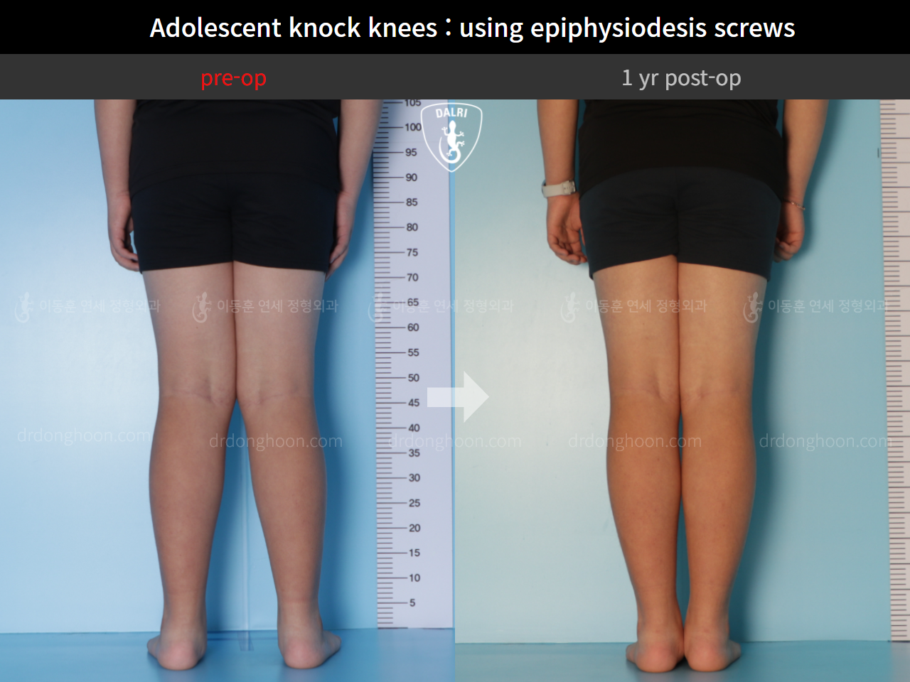 Before and after paediatric & adolescent knock knees, case 9331989, image 4, Dr. Donghoon institute (DALRI)