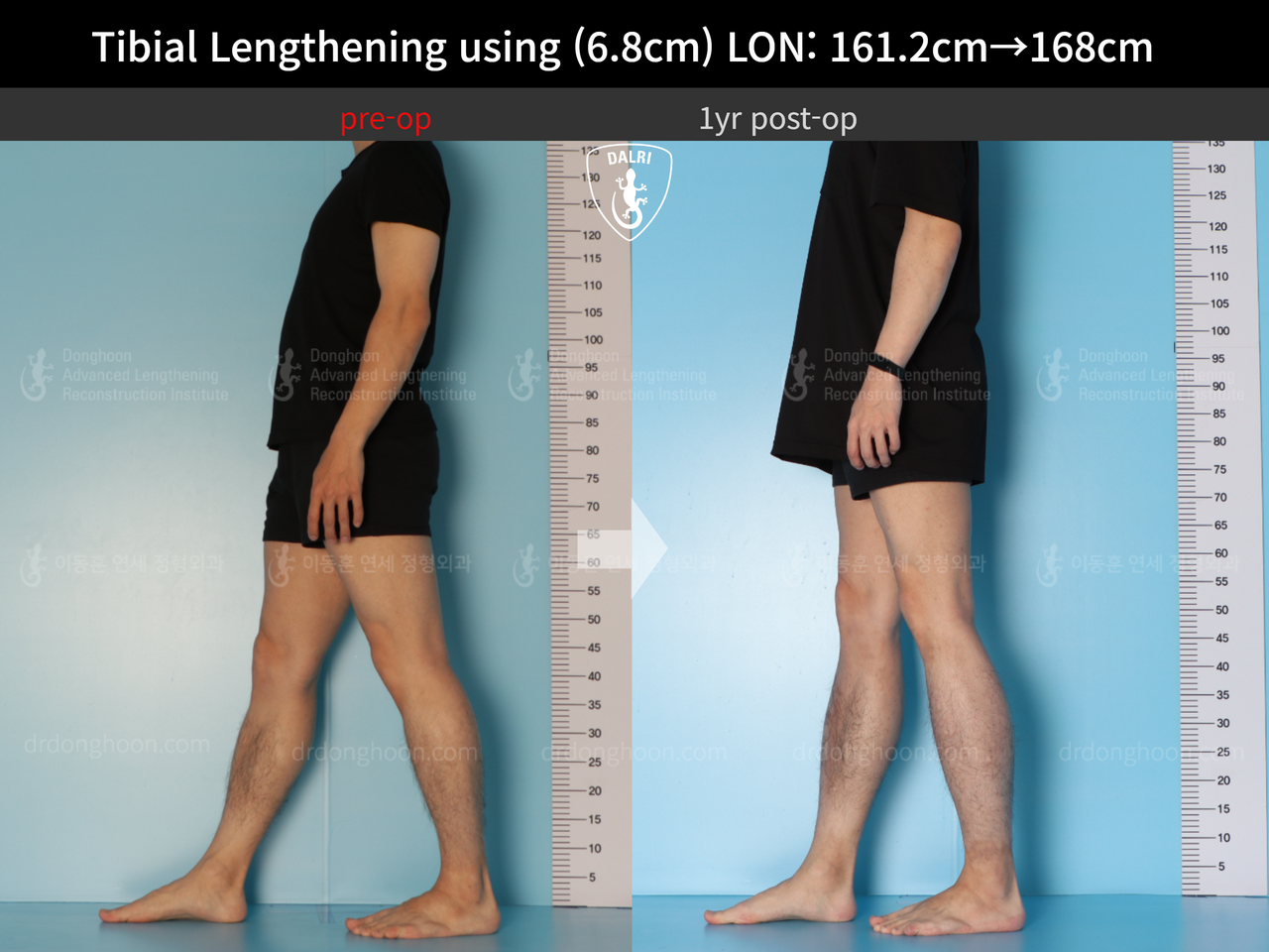 Before and after cll lon, case 13633878, image 4, Dr. Donghoon institute (DALRI)