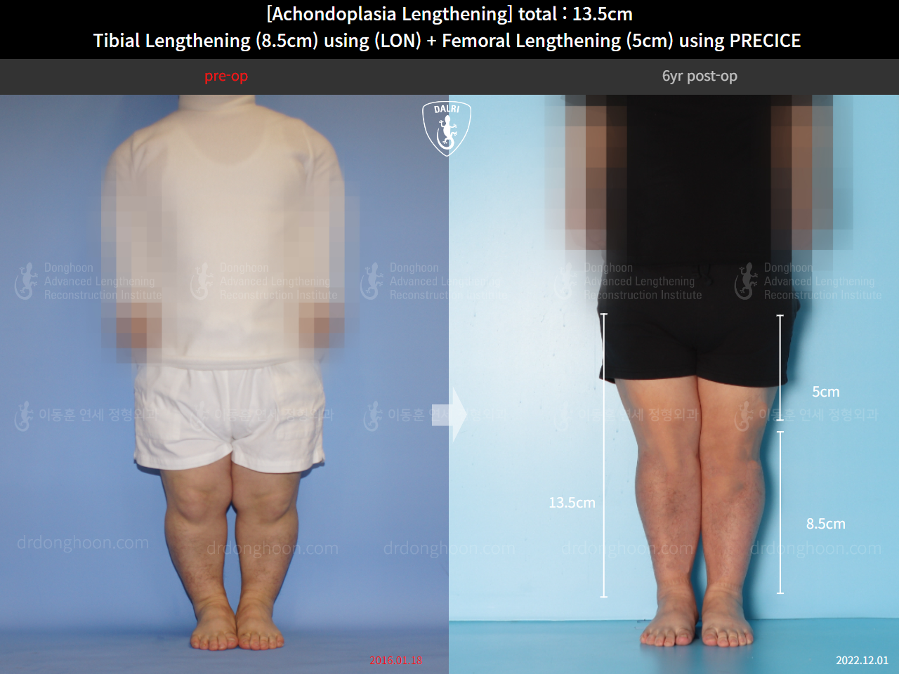 Before and after cll lon, case 14993527, image 5, Dr. Donghoon institute (DALRI)