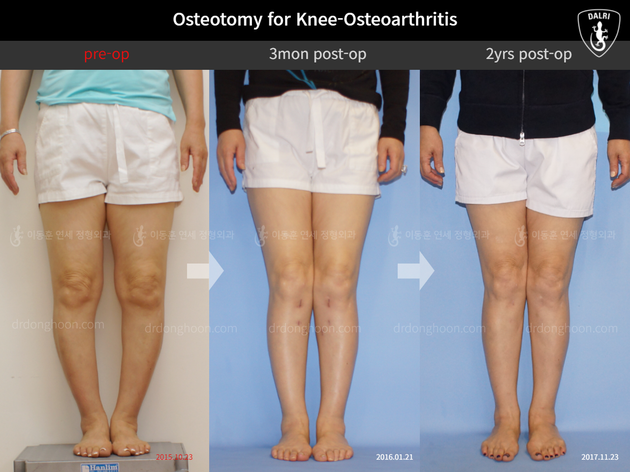Before and after osteotomy for knee osteoarthritis, case 11785573, image 3, Dr. Donghoon institute (DALRI)