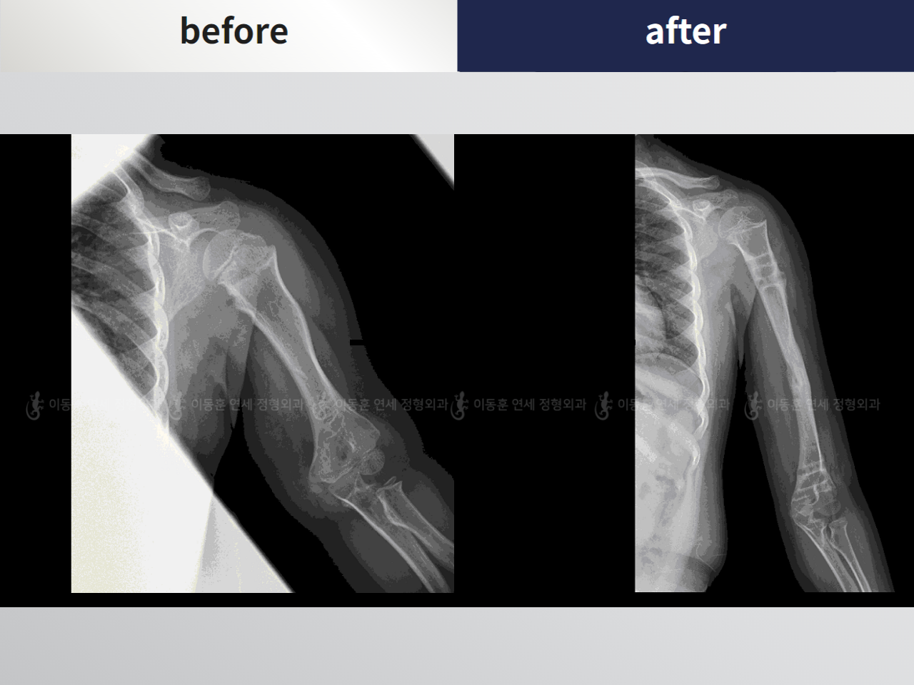 Before and after arm lengthening, case 4249492, image 2, Dr. Donghoon institute (DALRI)
