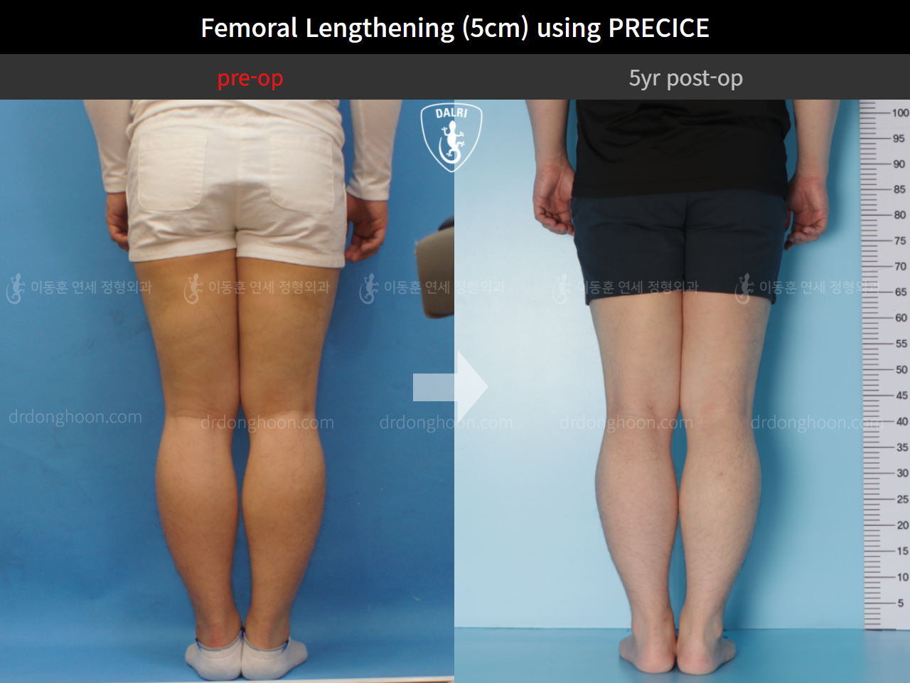 Before and after cll precice, case 4573586, image 4, Dr. Donghoon institute (DALRI)