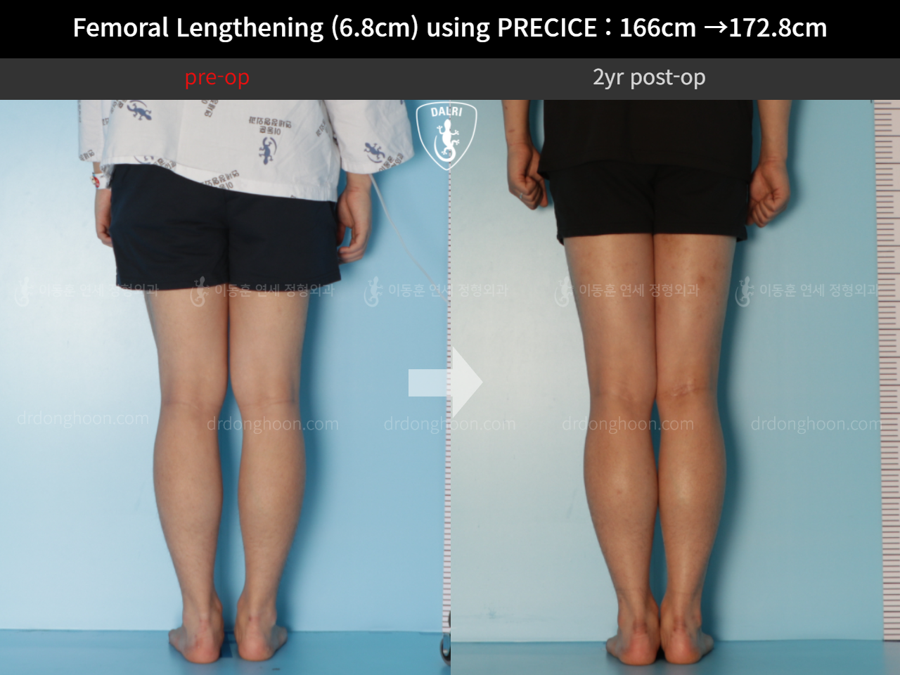Before and after cll precice, case 10883099, image 6, Dr. Donghoon institute (DALRI)