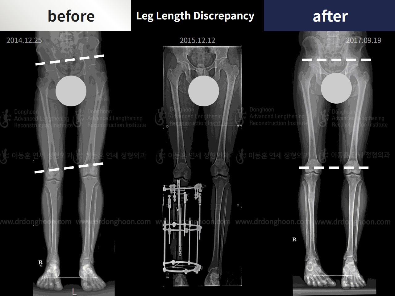 Before and after adult lld, case 4320297, image 3, Dr. Donghoon institute (DALRI)