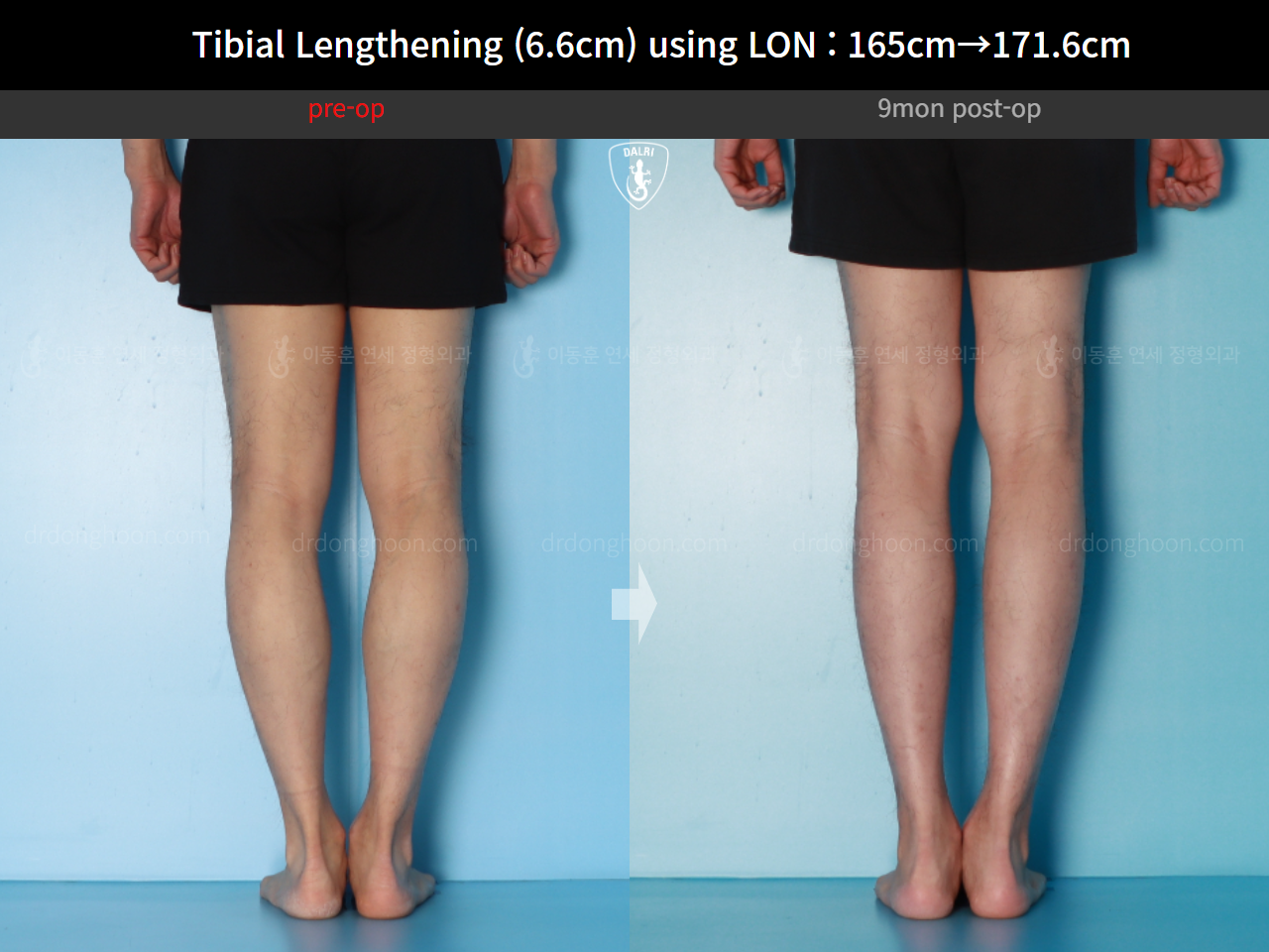 Before and after cll lon, case 16780660, image 10, Dr. Donghoon institute (DALRI)