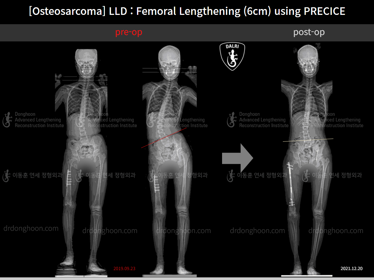 Before and after post-trauma deformity, case 11378057, image 5, Dr. Donghoon institute (DALRI)