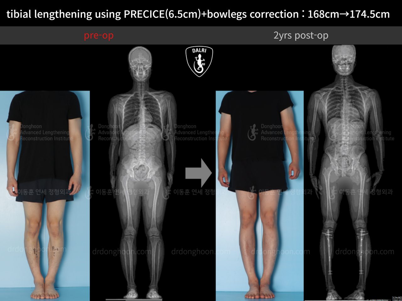 Before and after cll + deformity correction, case 12410003, image 1, Dr. Donghoon institute (DALRI)