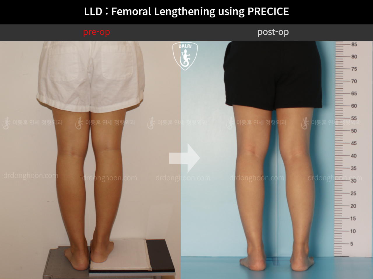 Before and after adult lld, case 10713336, image 4, Dr. Donghoon institute (DALRI)