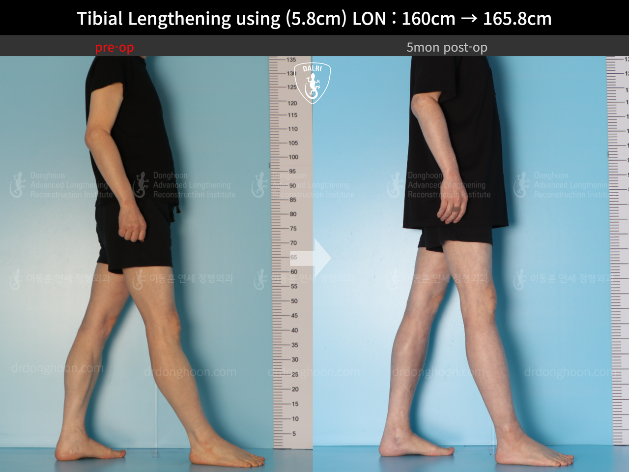 ภาพก่อน-หลัง ยืดขาเทคนิค LON เคสที่ 13414044 ภาพที่ 3 จากโรงพยาบาลศัลยกรรมกระดูกลีดงฮุน (DALRI)