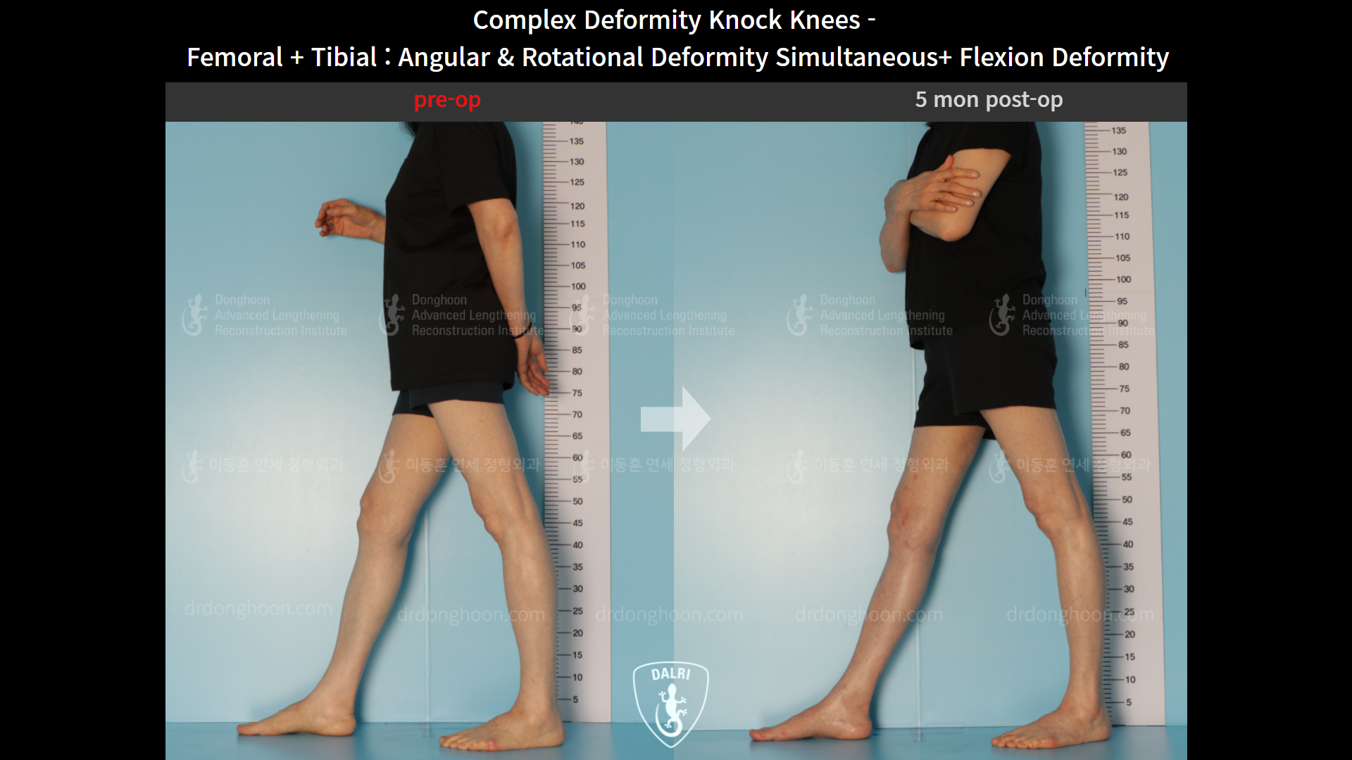 Before and after adult knock knees, case 9153798, image 3, Dr. Donghoon institute (DALRI)