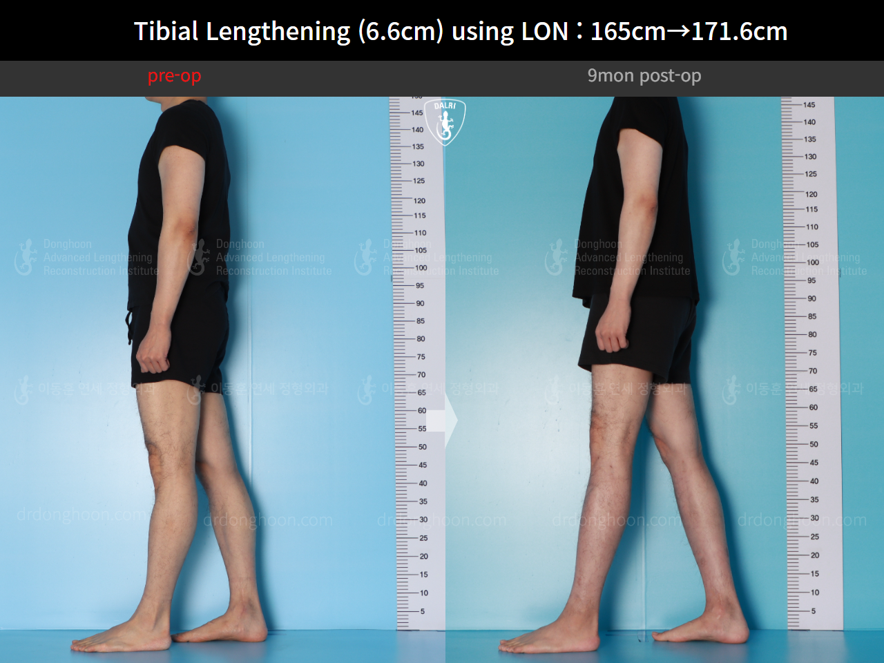 Before and after cll lon, case 16780660, image 5, Dr. Donghoon institute (DALRI)