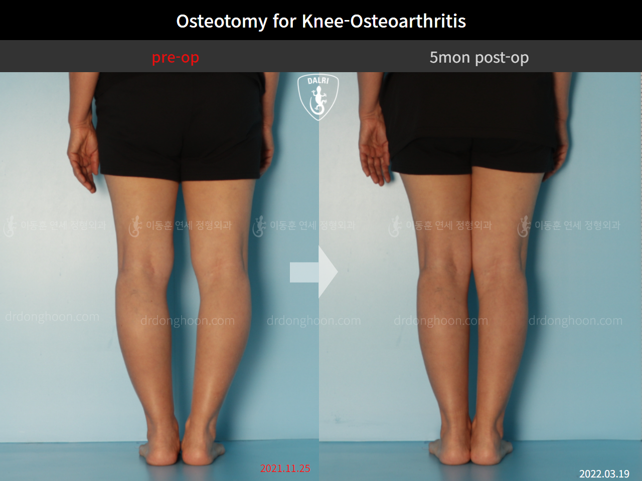 Before and after osteotomy for knee osteoarthritis, case 11047064, image 6, Dr. Donghoon institute (DALRI)