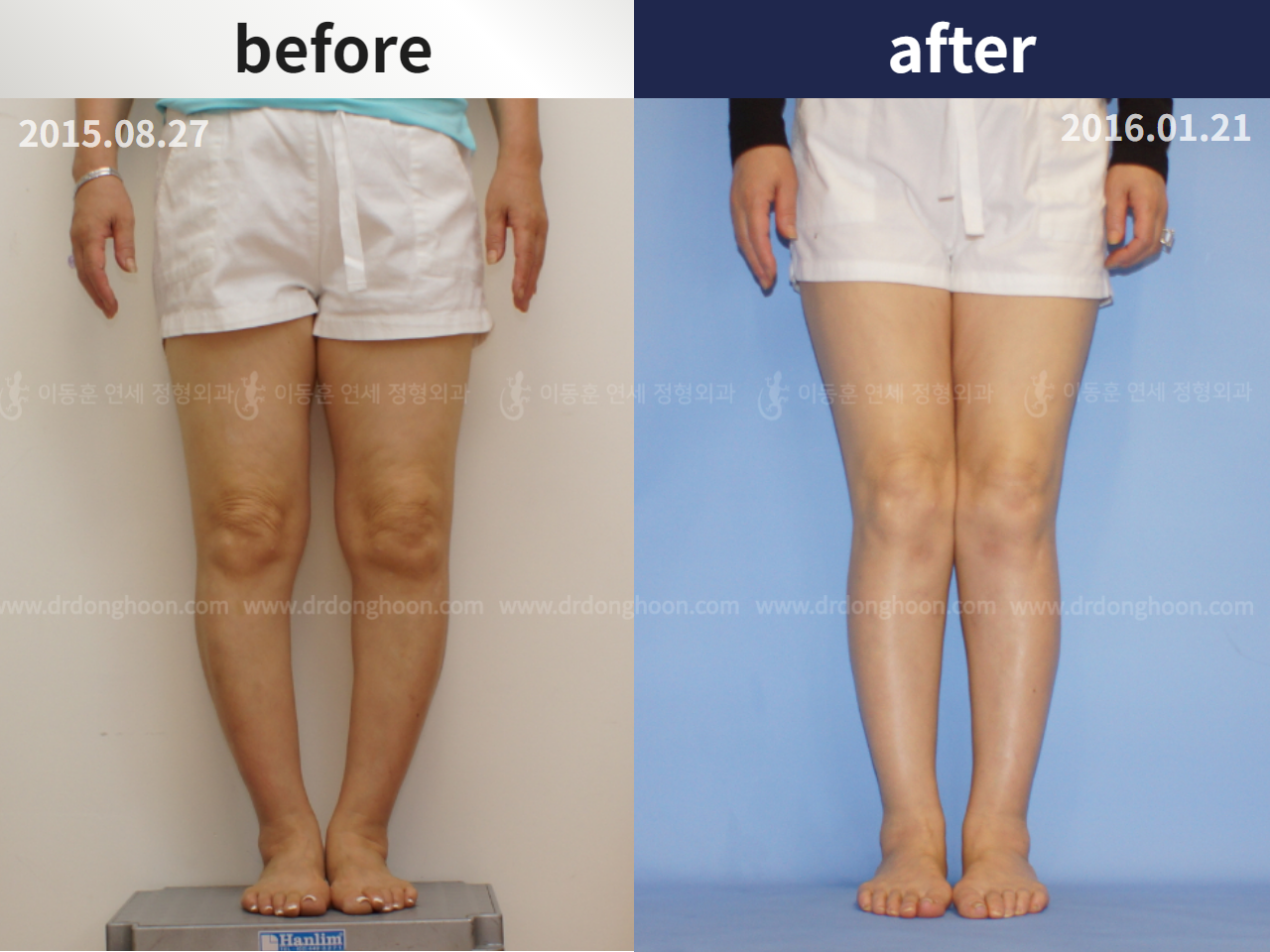 Before and after osteotomy for knee osteoarthritis, case 4306408, image 1, Dr. Donghoon institute (DALRI)