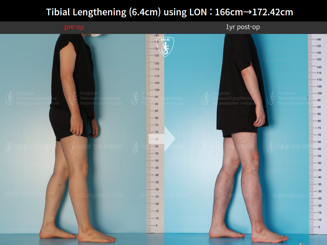 Before and after cll lon, case 15889727, image 3, Dr. Donghoon institute (DALRI)