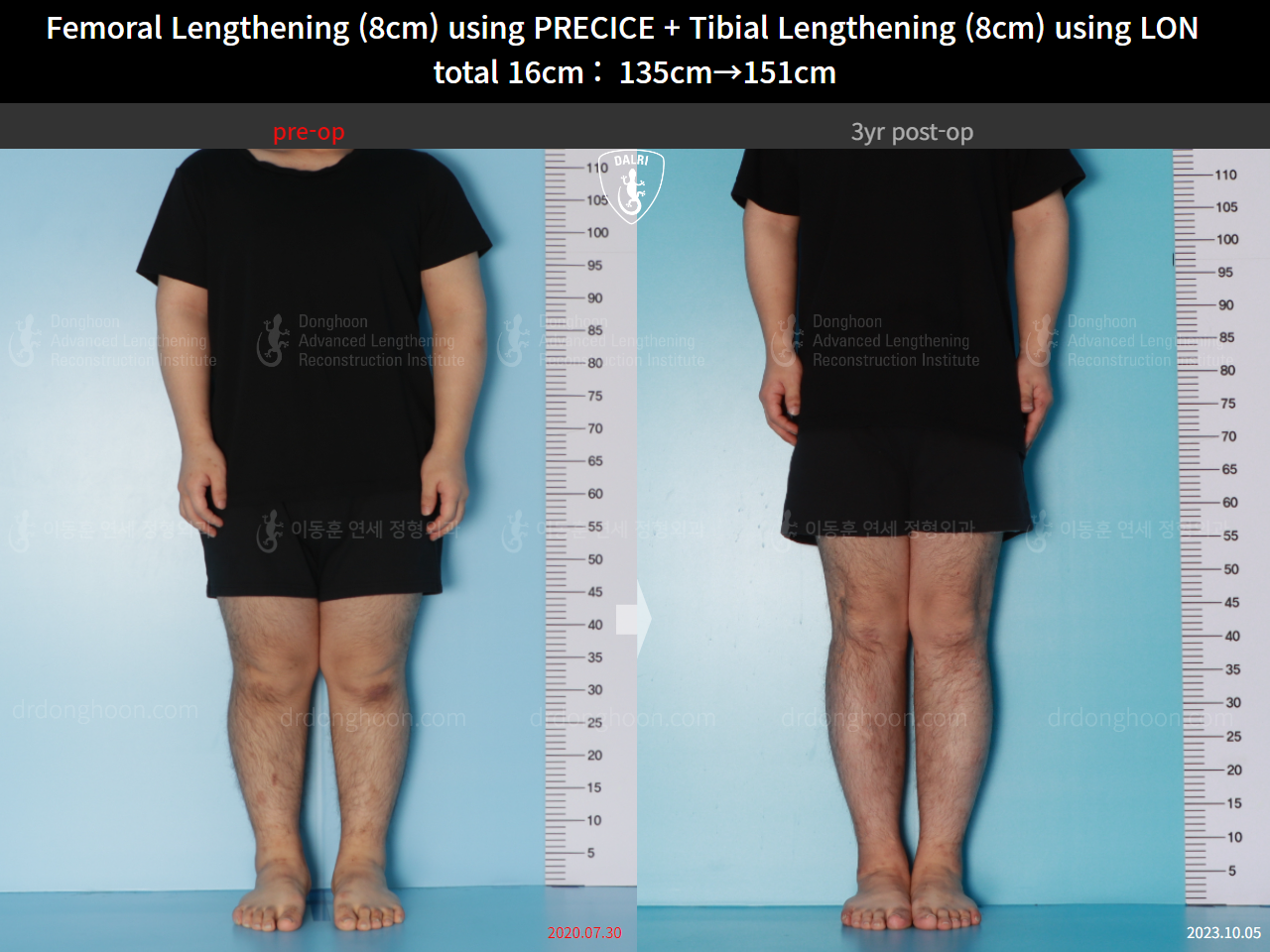 Before and after cll lon, case 16524730, image 5, Dr. Donghoon institute (DALRI)