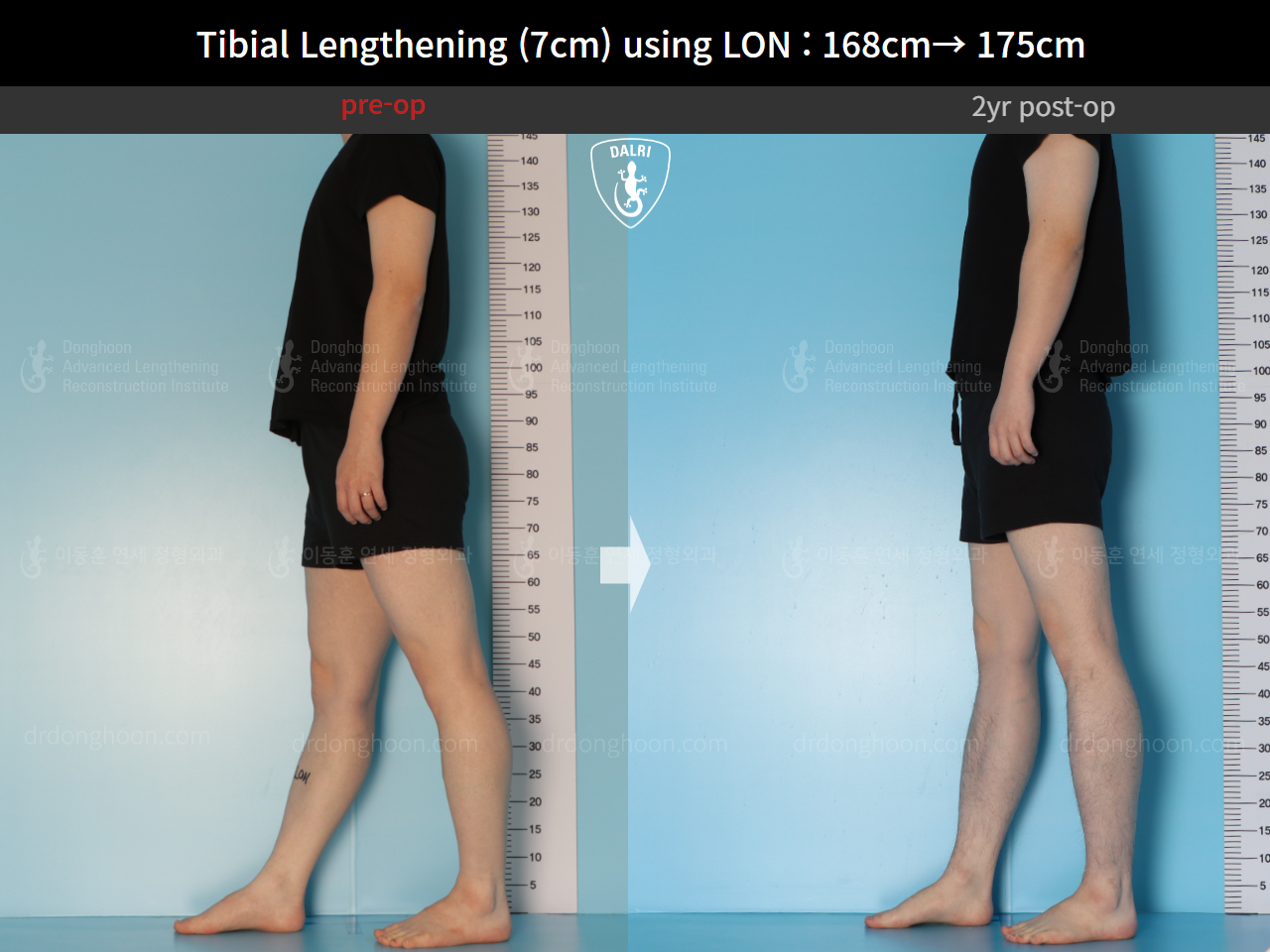 Before and after cll lon, case 14978046, image 4, Dr. Donghoon institute (DALRI)