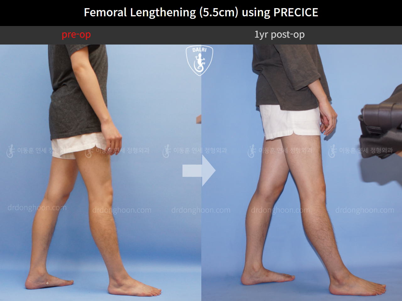 Before and after cll precice, case 4323383, image 4, Dr. Donghoon institute (DALRI)