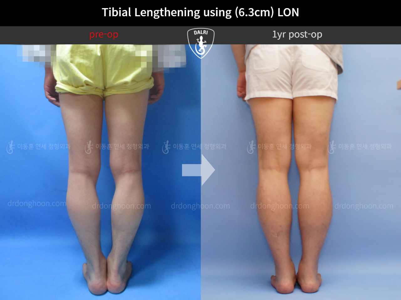 Before and after cll lon, case 4577838, image 6, Dr. Donghoon institute (DALRI)