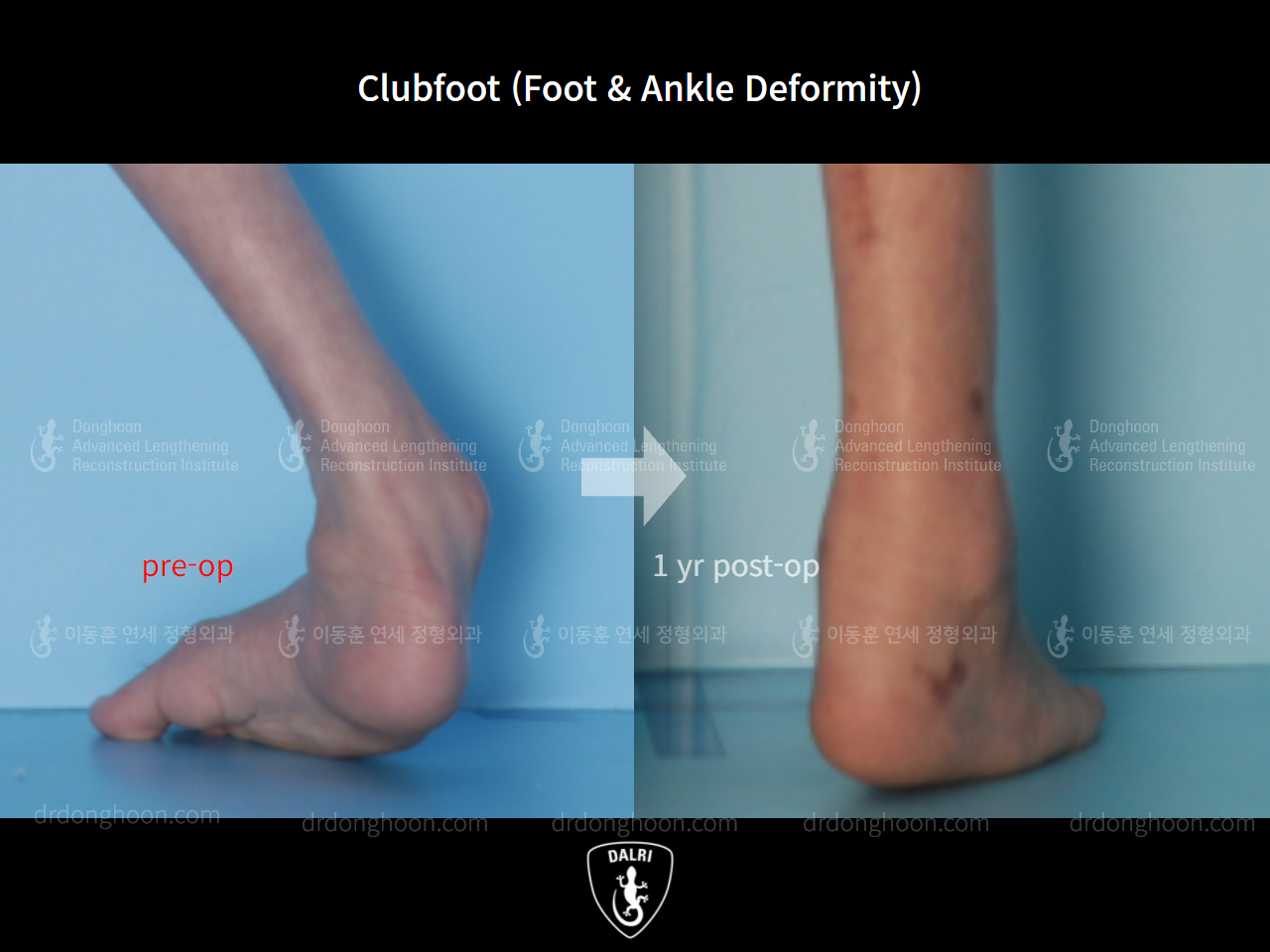 Before and after foot & ankle deformity, case 9231539, image 4, Dr. Donghoon institute (DALRI)