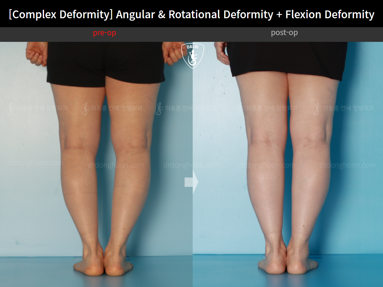 Before and after adult bowlegs, case 16781344, image 9, Dr. Donghoon institute (DALRI)