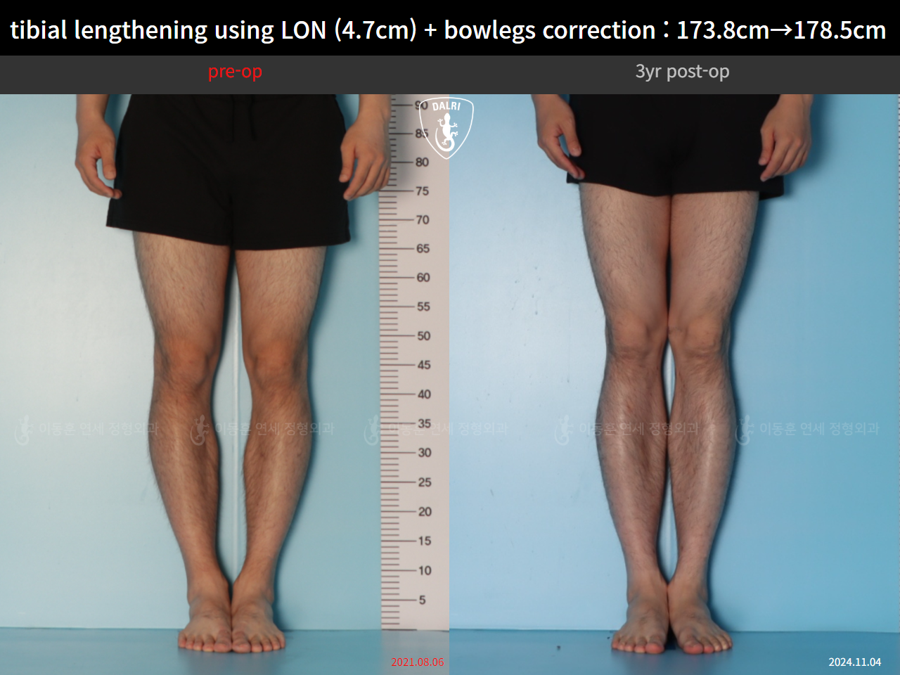 Before and after cll lon, case 128583026, image 7, Dr. Donghoon institute (DALRI)