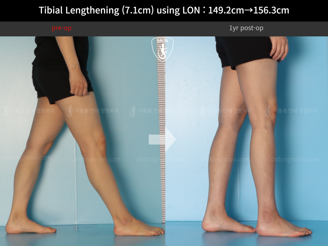 Before and after cll lon, case 14264800, image 7, Dr. Donghoon institute (DALRI)