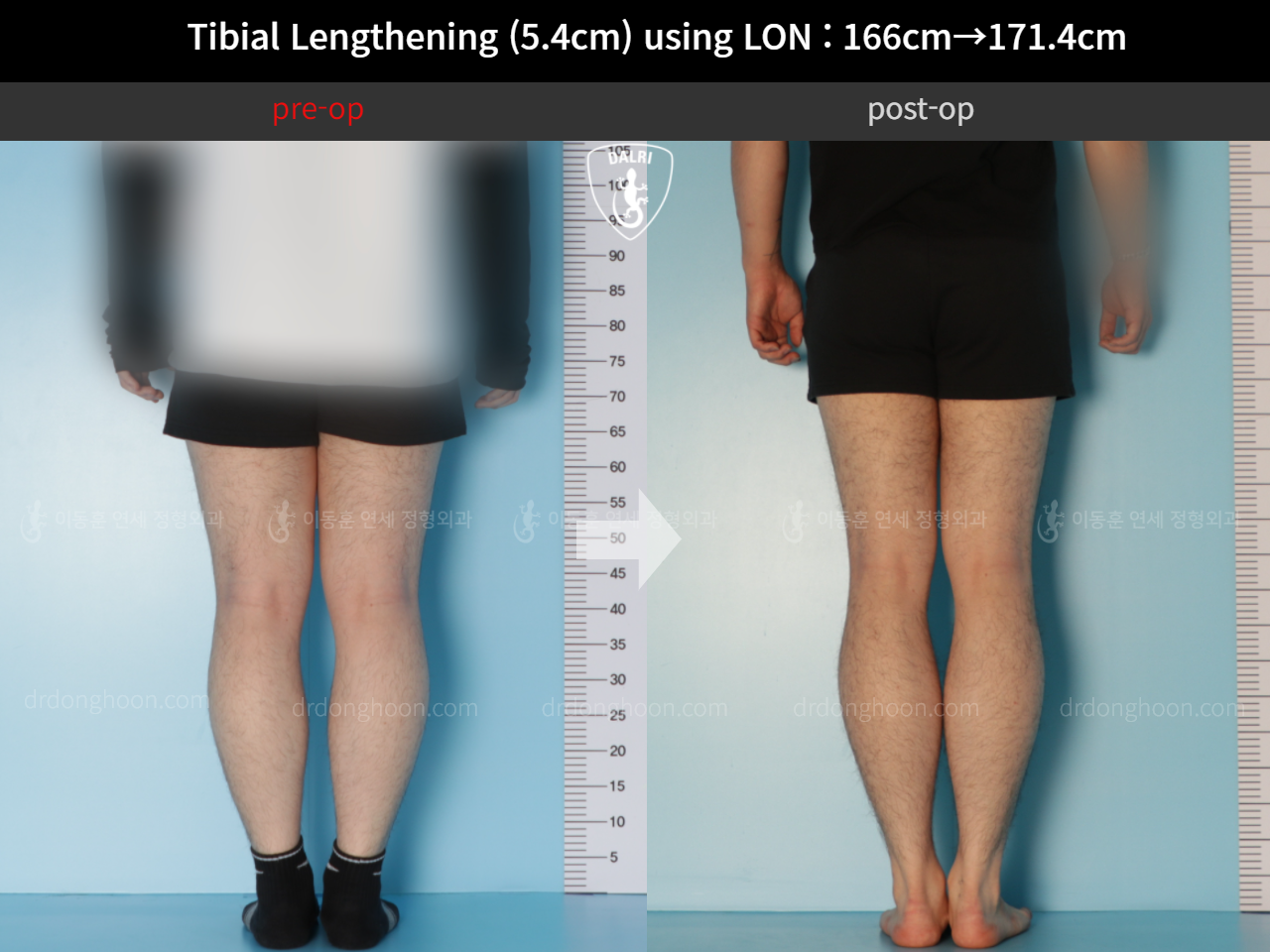 Before and after cll lon, case 11831572, image 6, Dr. Donghoon institute (DALRI)