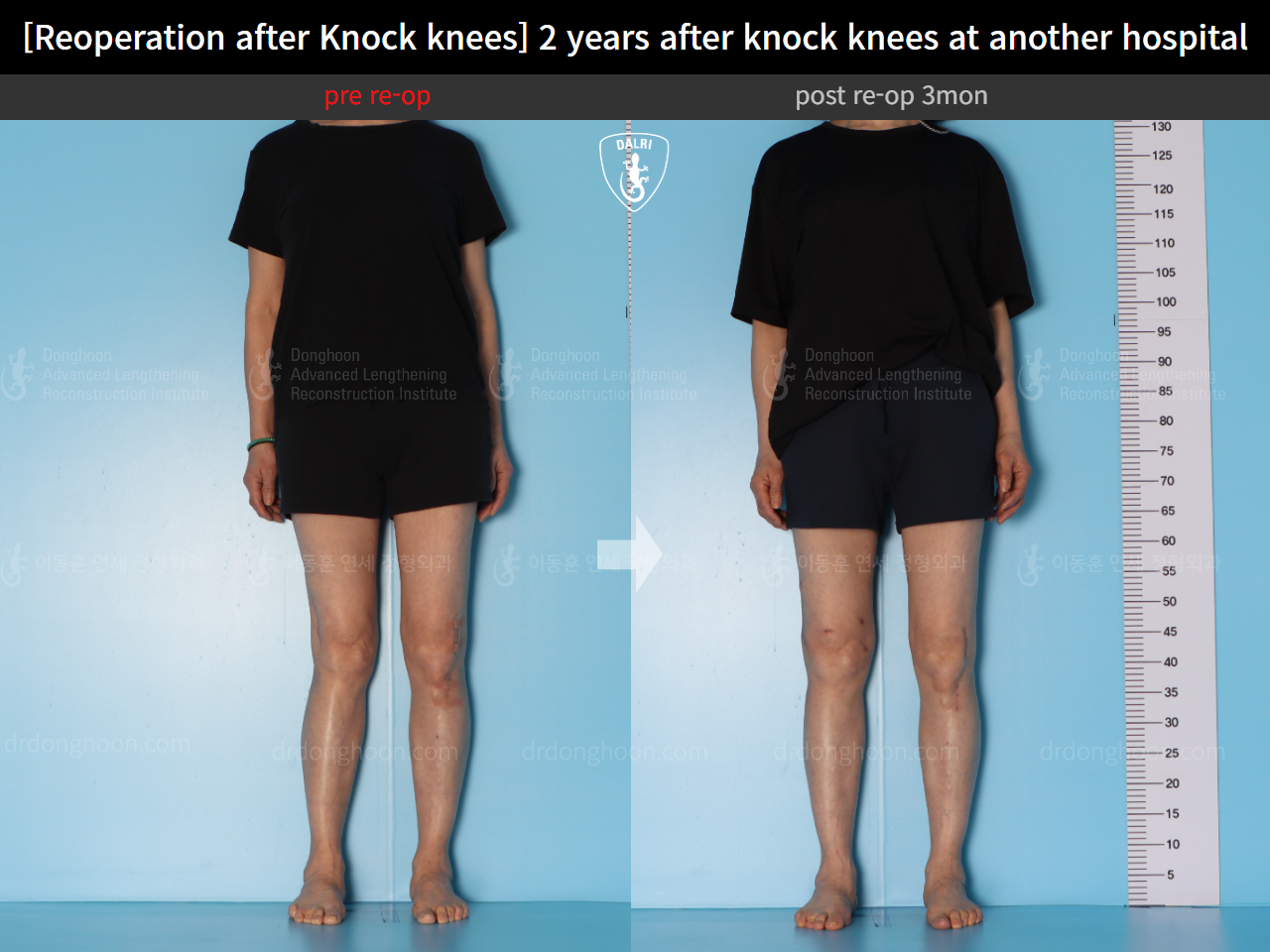 Before and after reoperation after deformity correction, case 15622876, image 3, Dr. Donghoon institute (DALRI)