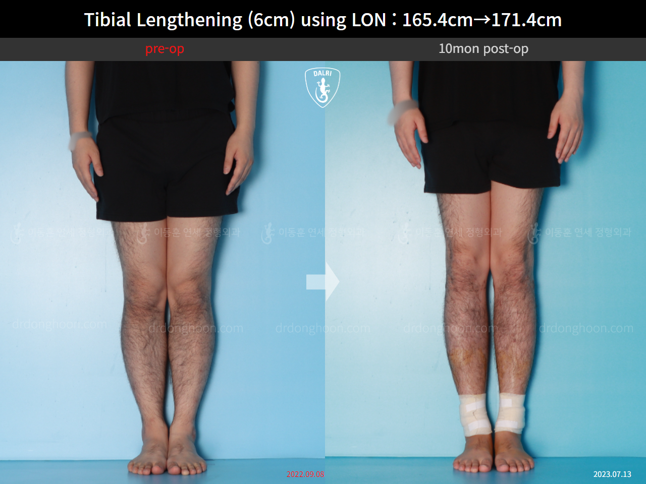 Before and after cll lon, case 15716525, image 9, Dr. Donghoon institute (DALRI)