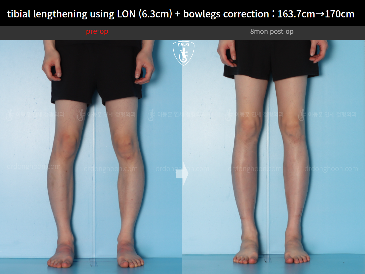Before and after cll + deformity correction, case 16853829, image 8, Dr. Donghoon institute (DALRI)
