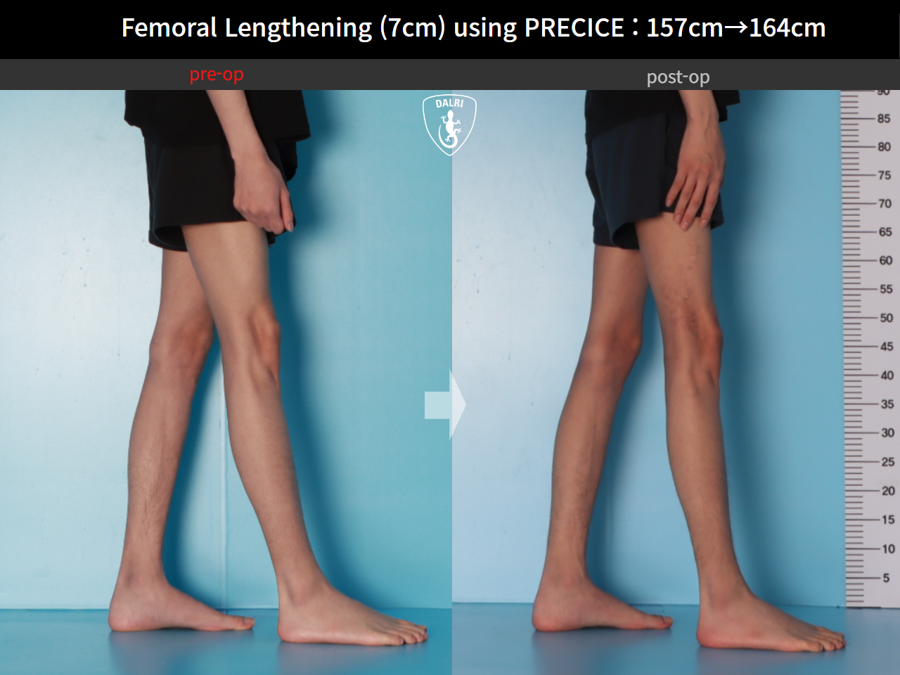 Before and after cll precice, case 31554406, image 10, Dr. Donghoon institute (DALRI)
