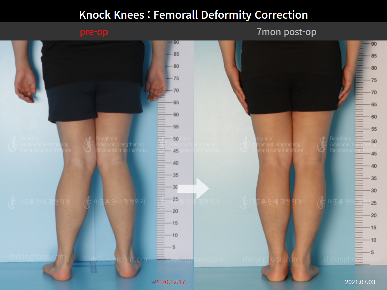 Before and after adult knock knees, case 8821218, image 2, Dr. Donghoon institute (DALRI)