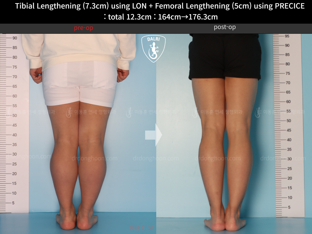 Before and after cll precice, case 13590455, image 6, Dr. Donghoon institute (DALRI)