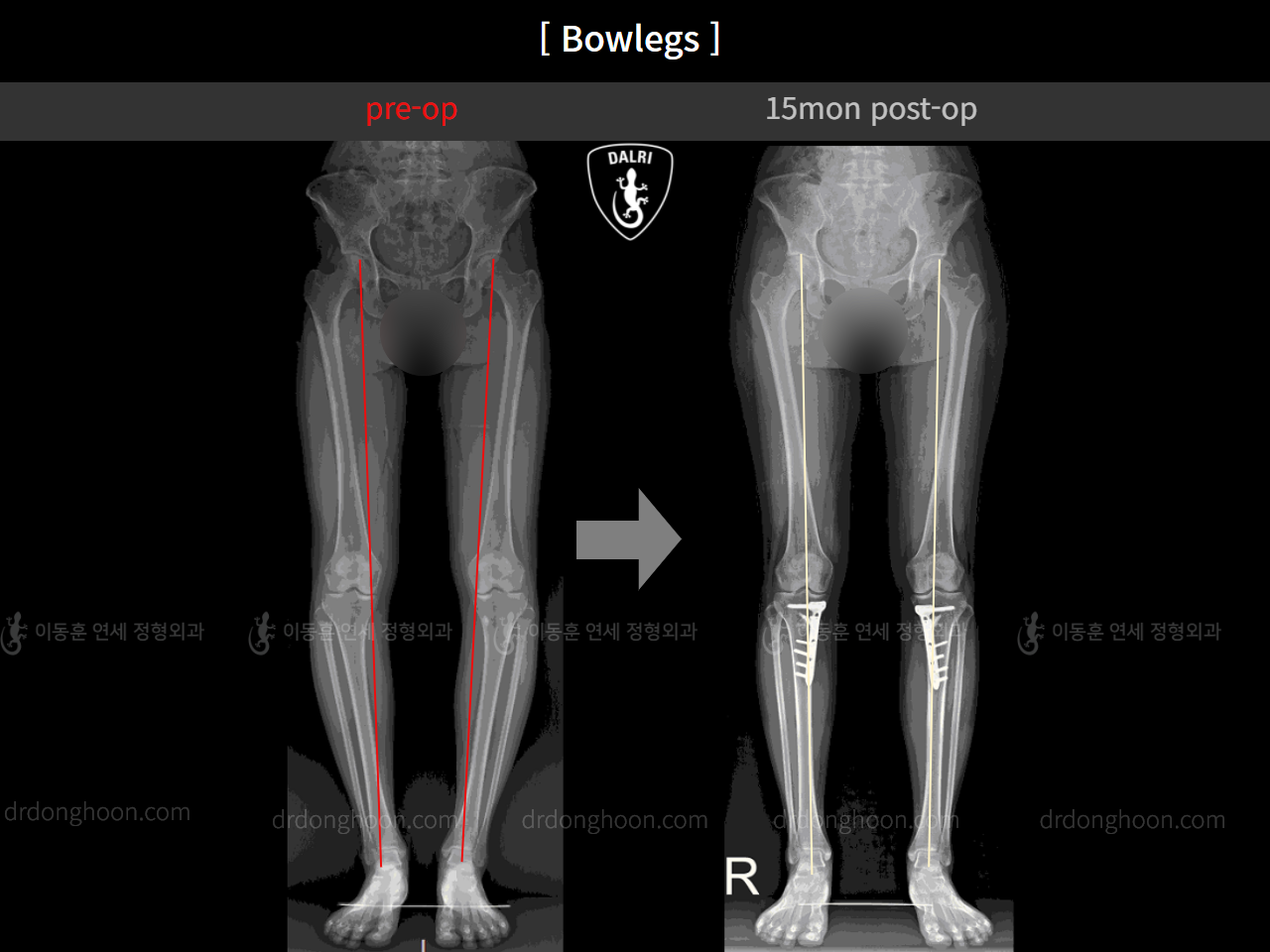 Before and after adult bowlegs, case 4311006, image 5, Dr. Donghoon institute (DALRI)