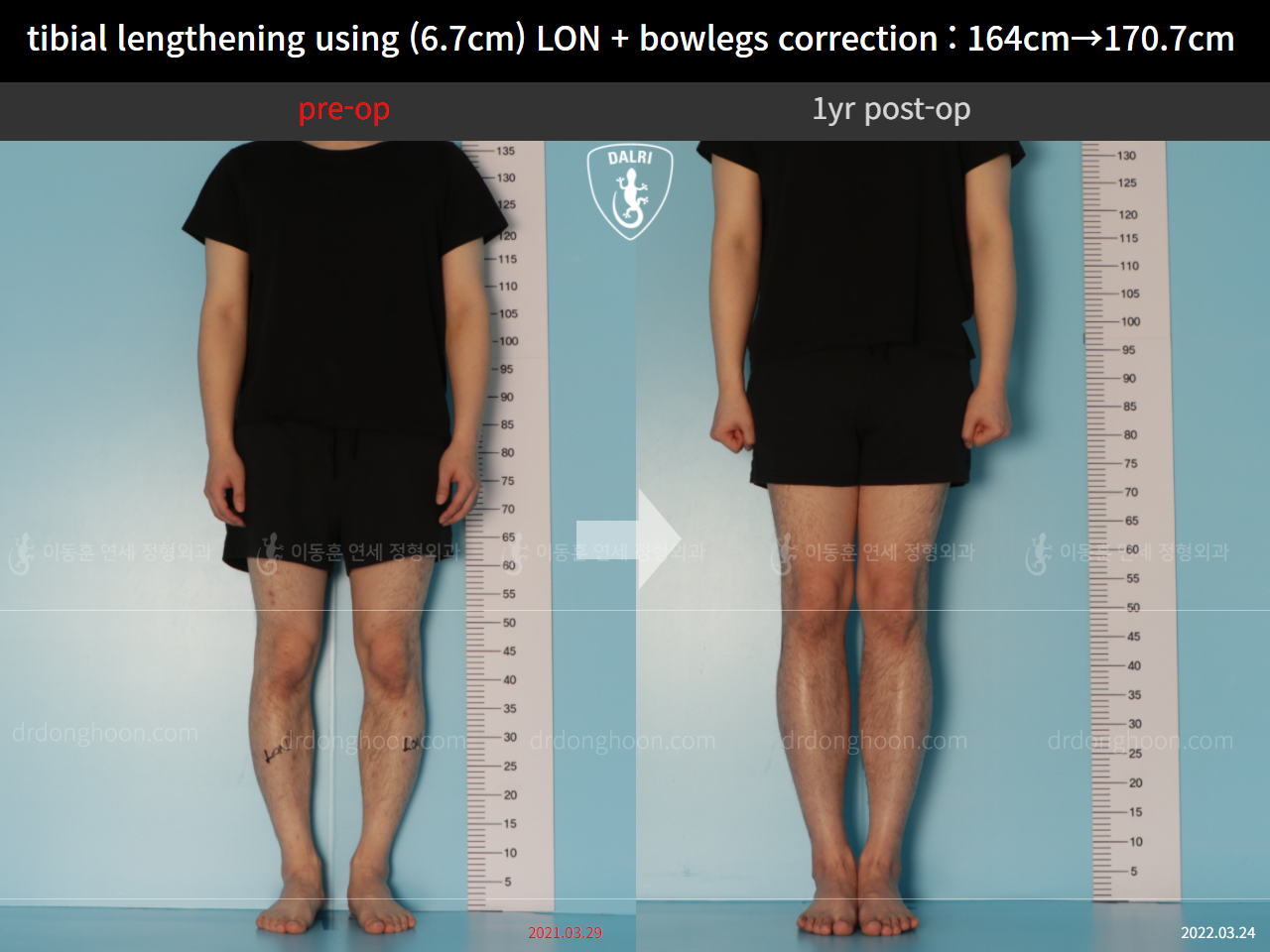 Before and after cll lon, case 11037334, image 1, Dr. Donghoon institute (DALRI)