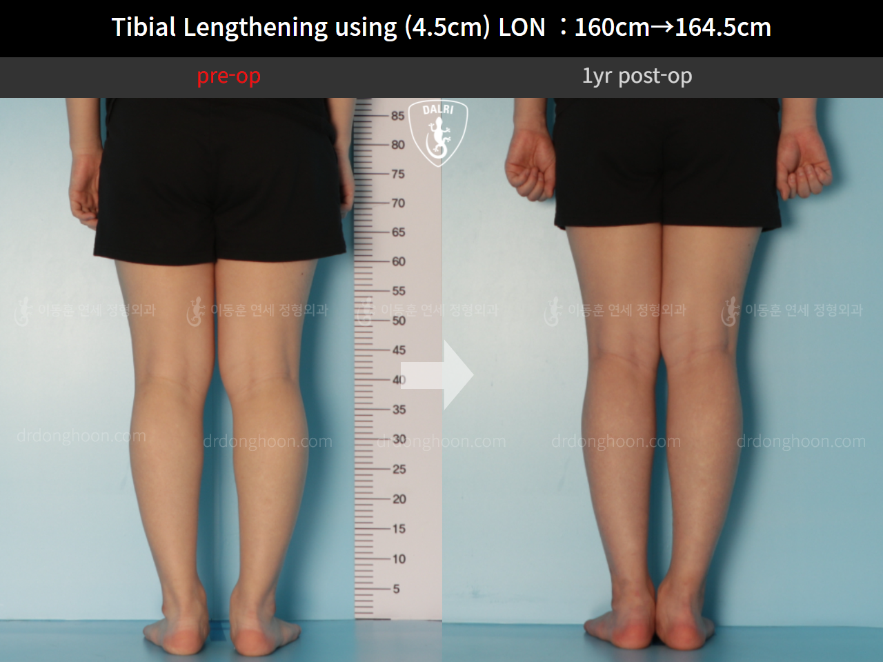 Before and after cll lon, case 10600029, image 6, Dr. Donghoon institute (DALRI)
