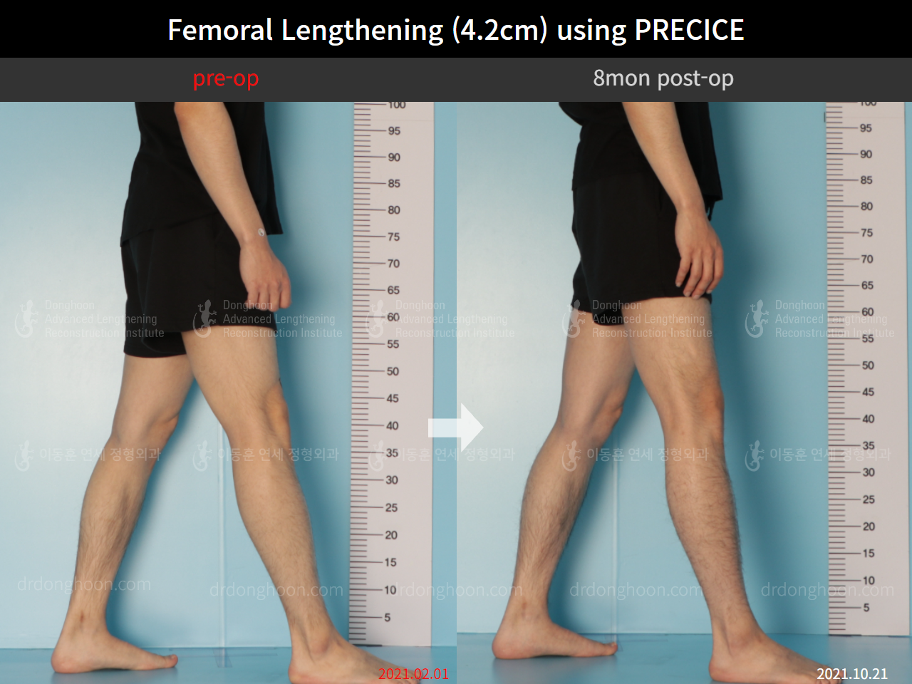 Before and after cll precice, case 8781700, image 7, Dr. Donghoon institute (DALRI)