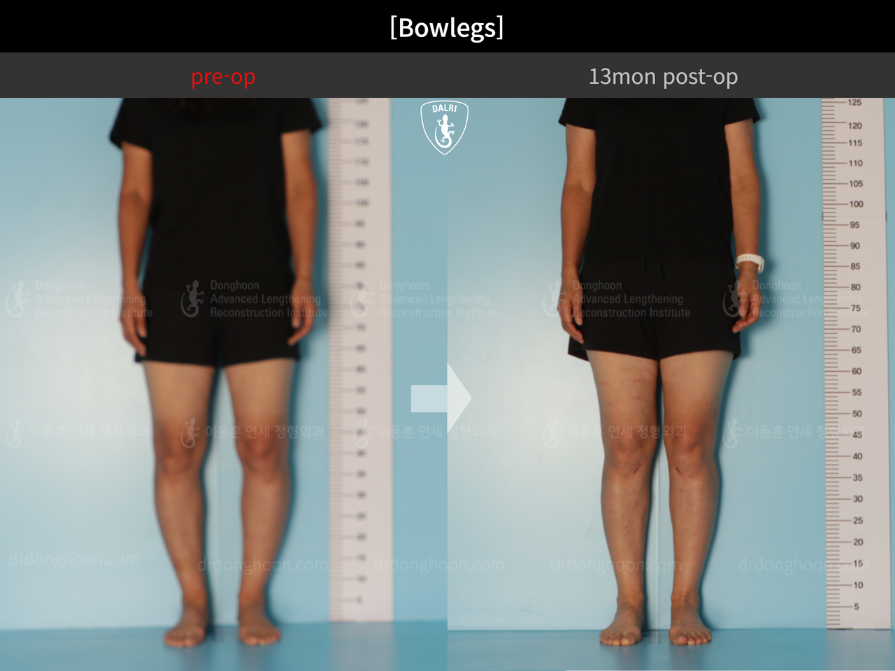 Before and after adult bowlegs, case 13223508, image 4, Dr. Donghoon institute (DALRI)