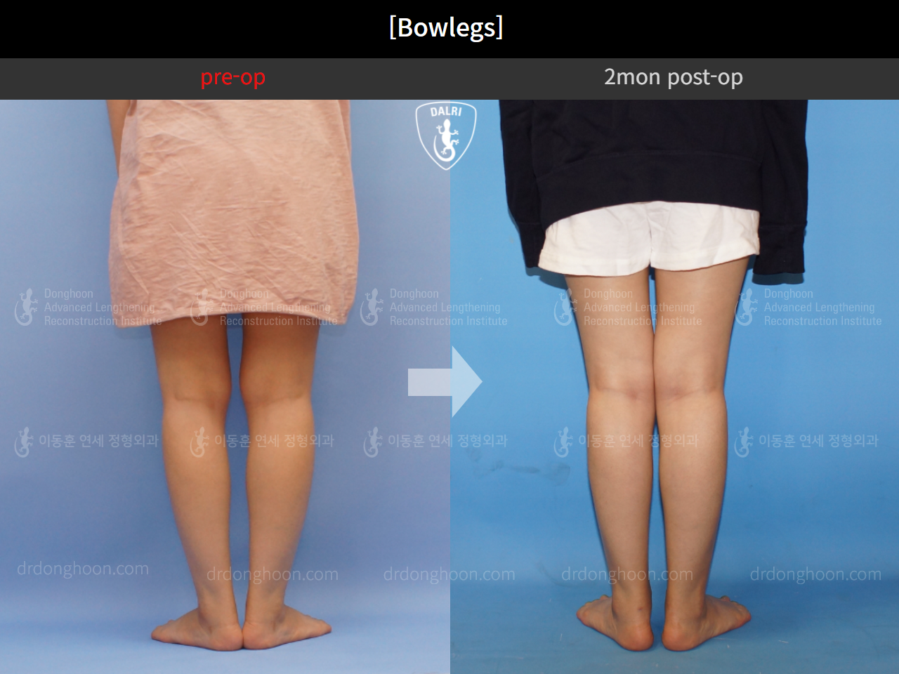 Before and after adult bowlegs, case 4310993, image 7, Dr. Donghoon institute (DALRI)