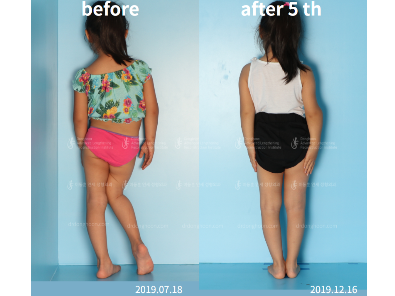 Before and after paediatric & adolescent lld, case 4577152, image 4, Dr. Donghoon institute (DALRI)