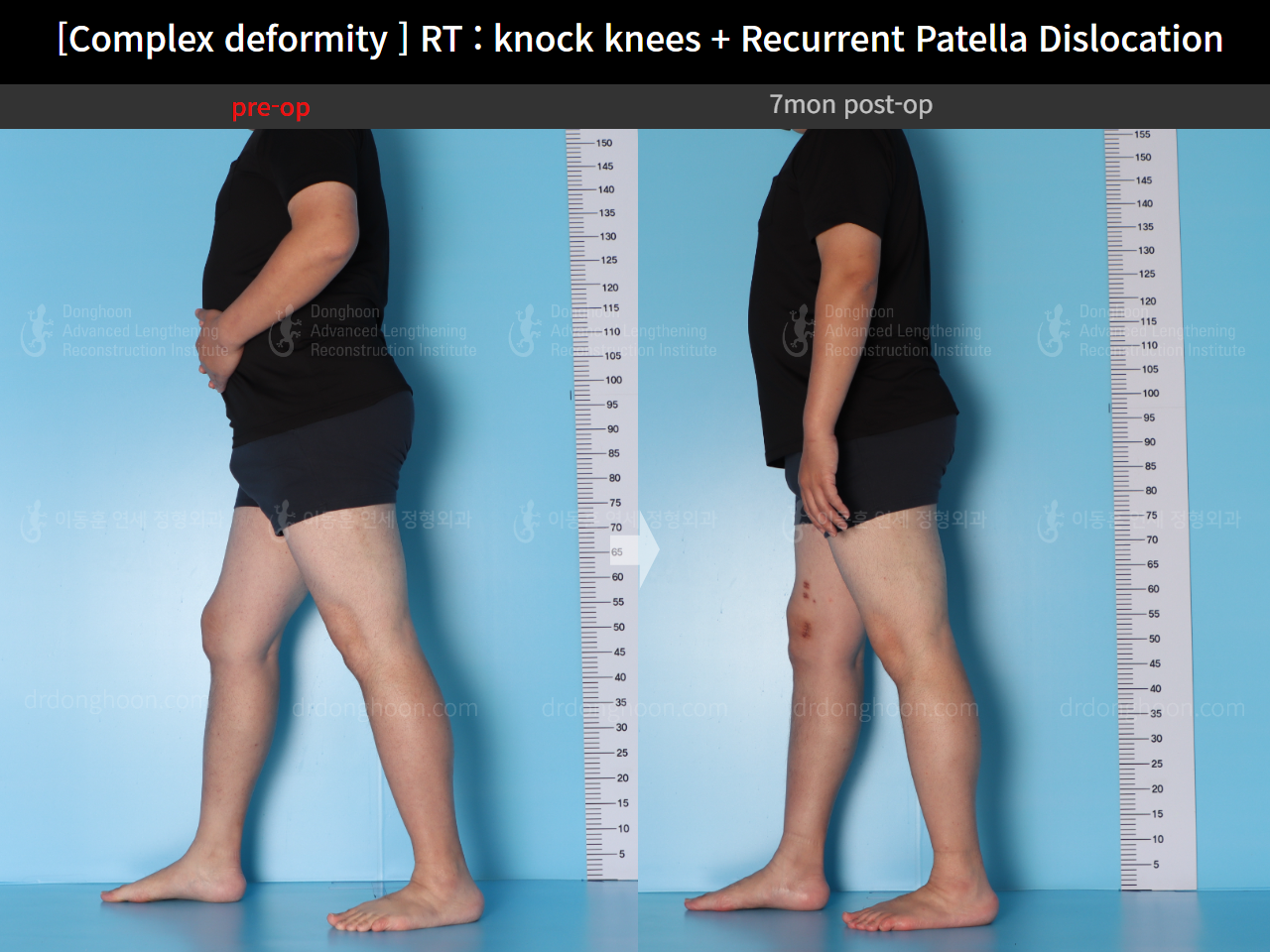 Before and after recurrent patella dislocation, case 16147031, image 6, Dr. Donghoon institute (DALRI)