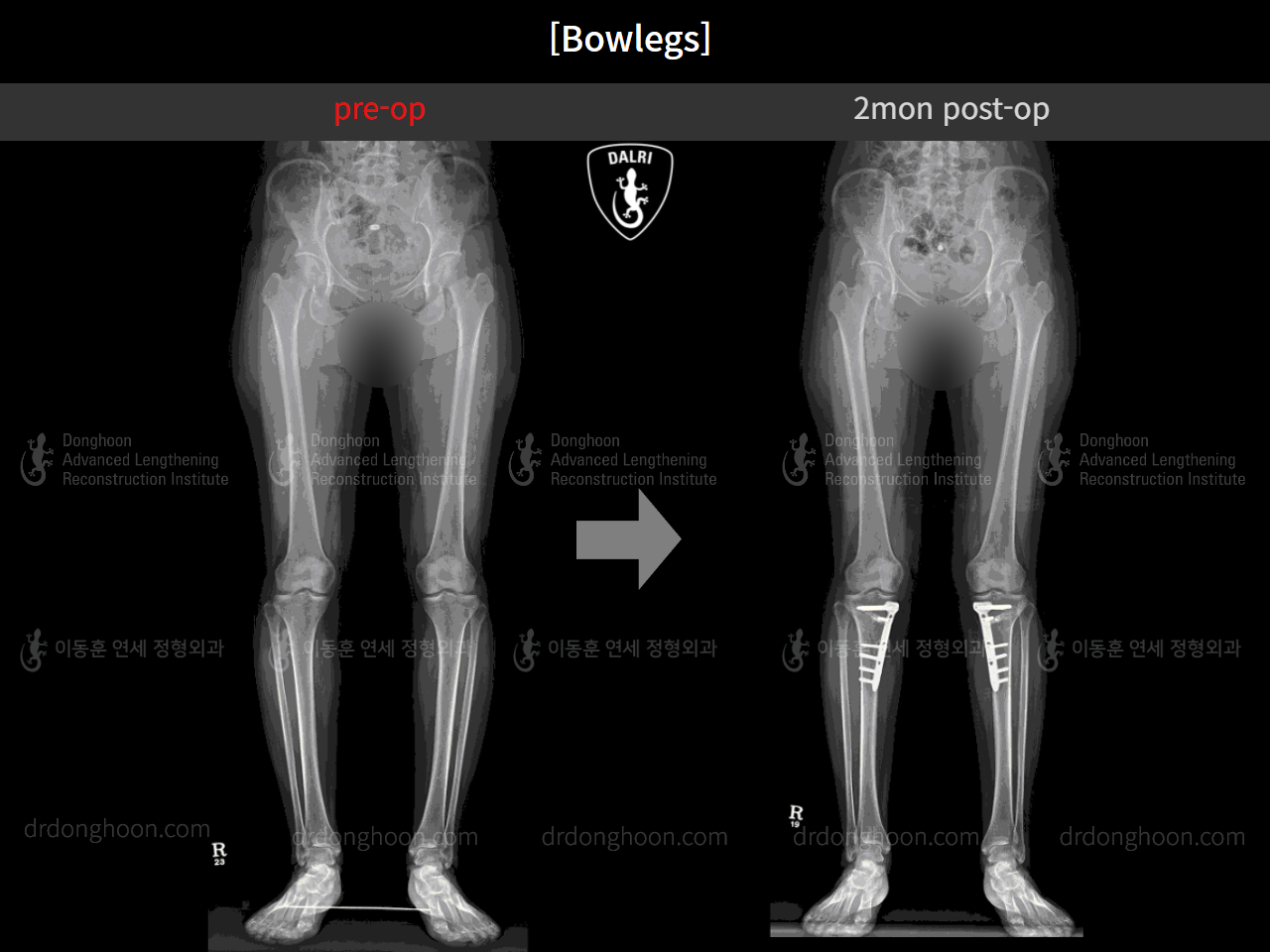 Before and after adult bowlegs, case 4310993, image 9, Dr. Donghoon institute (DALRI)