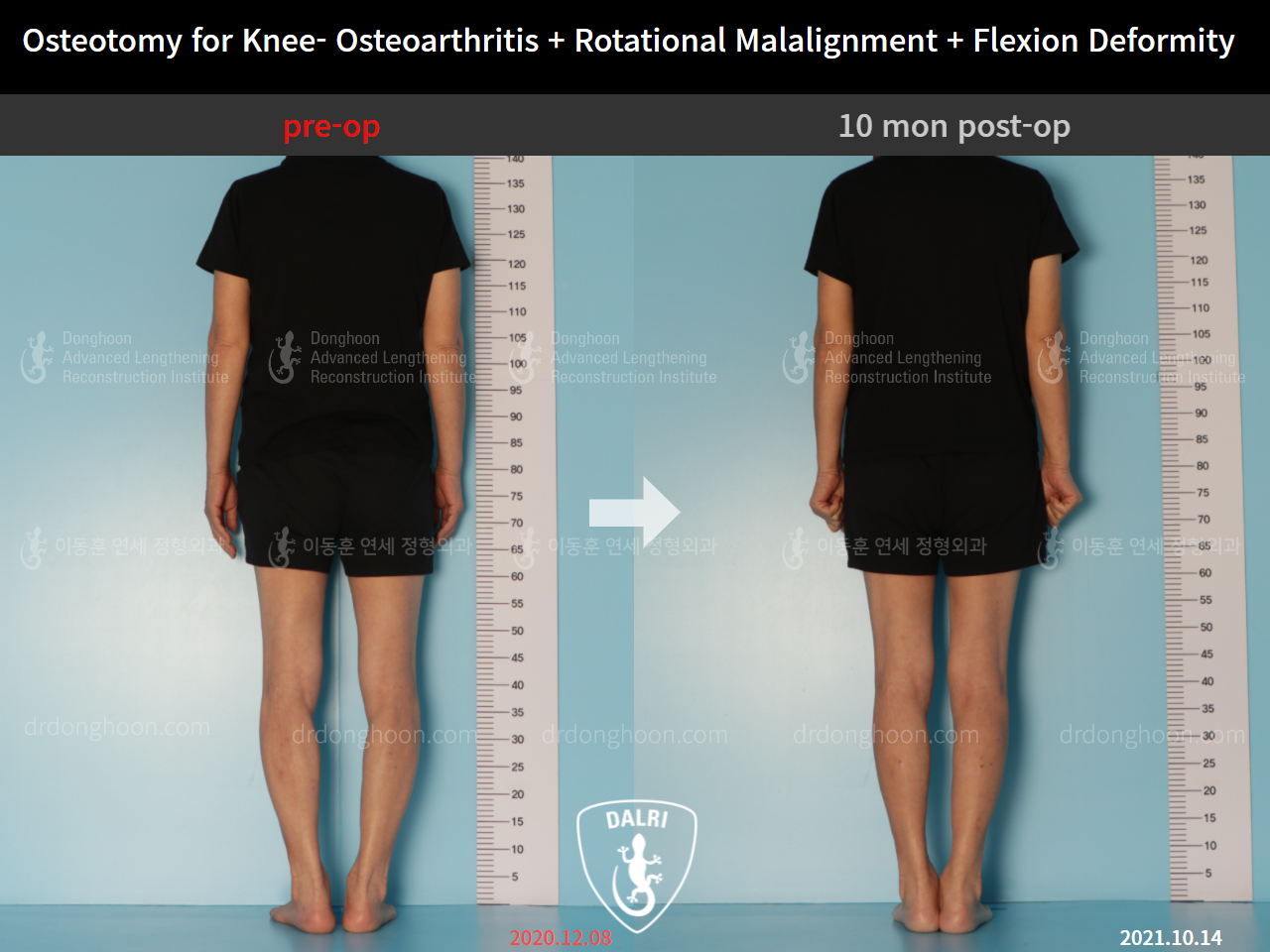 Before and after adult bowlegs, case 9128510, image 4, Dr. Donghoon institute (DALRI)