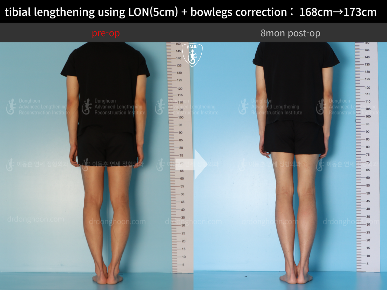 Tibial Lengthening Using LON(5cm) + Bowlegs Correction : 168cm→173cm ...