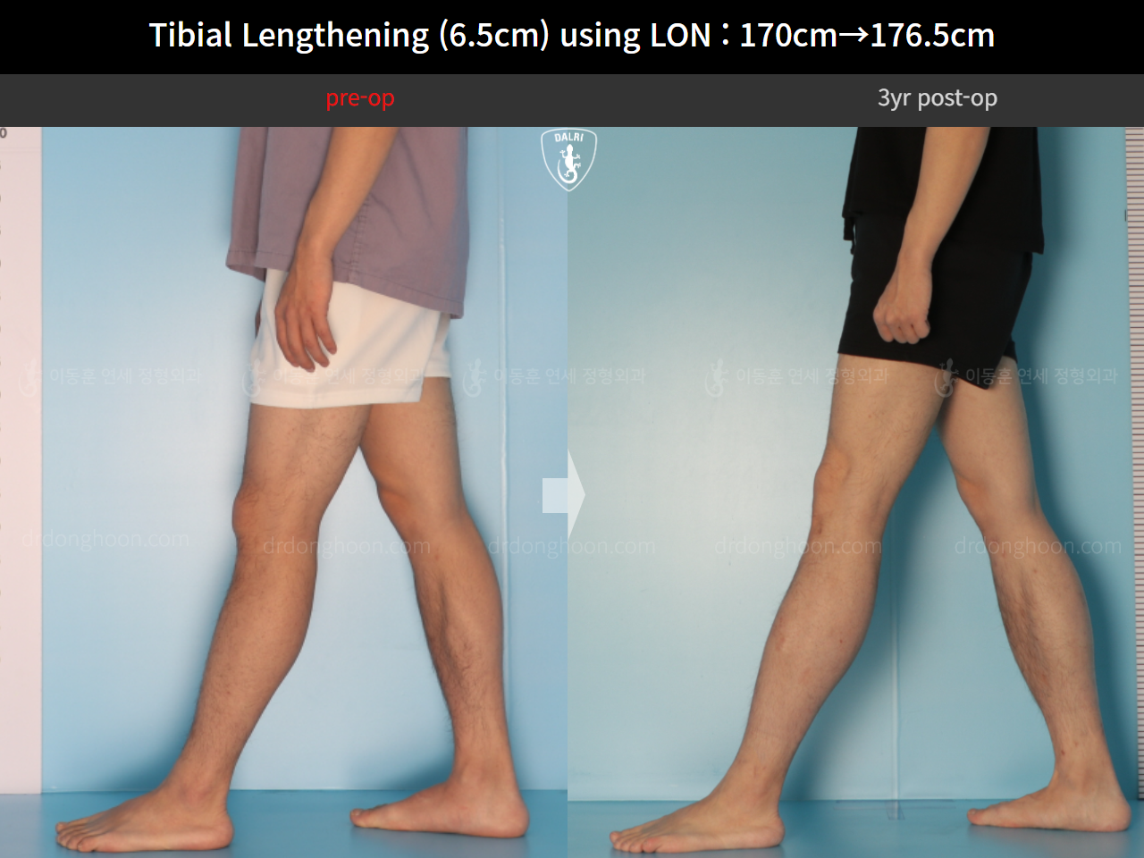 Before and after cll lon, case 16299082, image 7, Dr. Donghoon institute (DALRI)