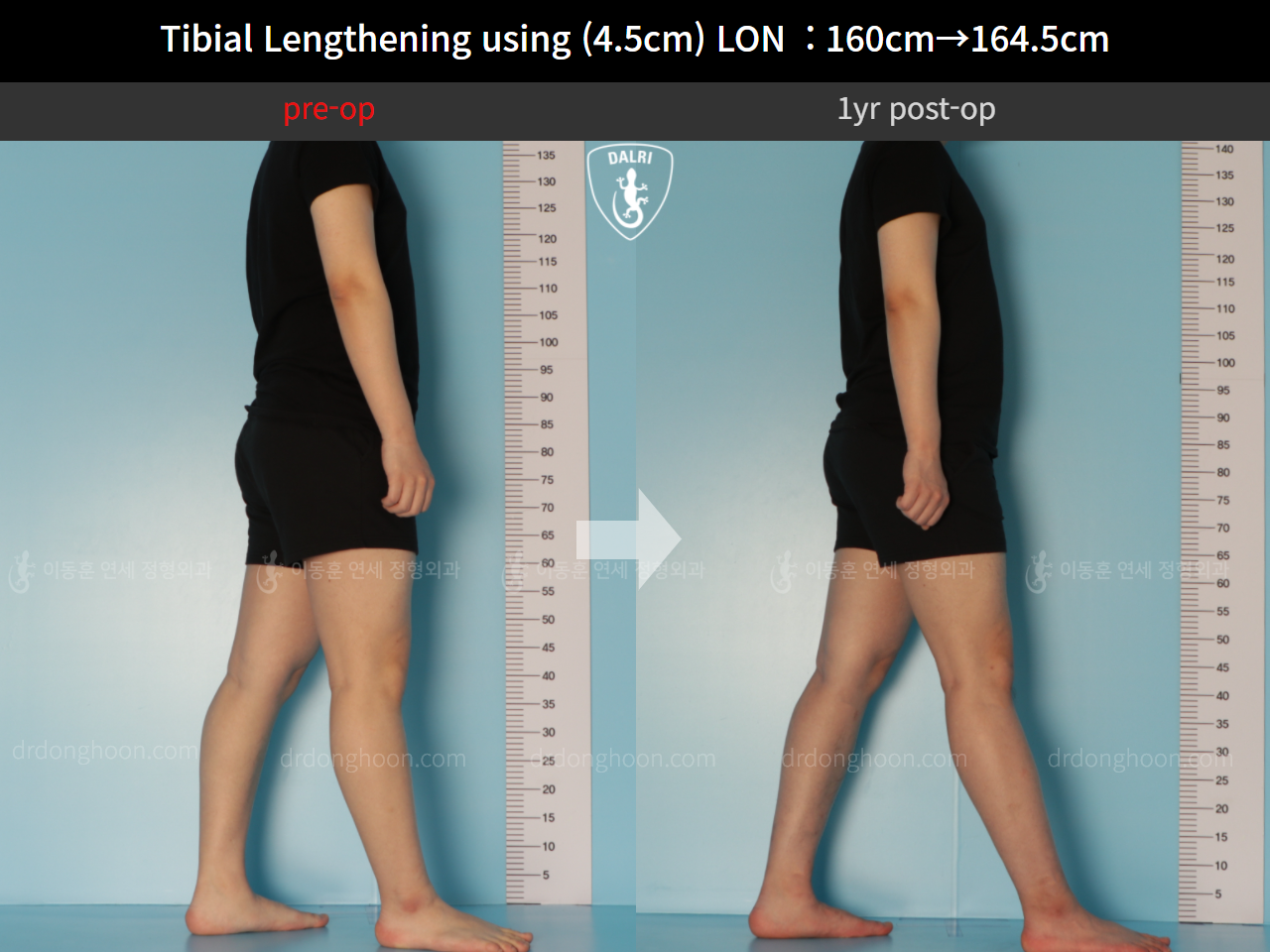 Before and after cll lon, case 10600029, image 4, Dr. Donghoon institute (DALRI)
