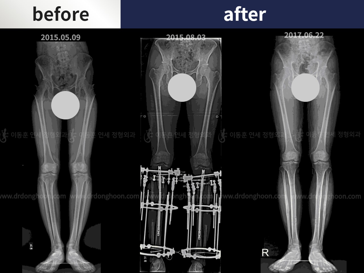 Before and after cll + deformity correction, case 4323161, image 4, Dr. Donghoon institute (DALRI)