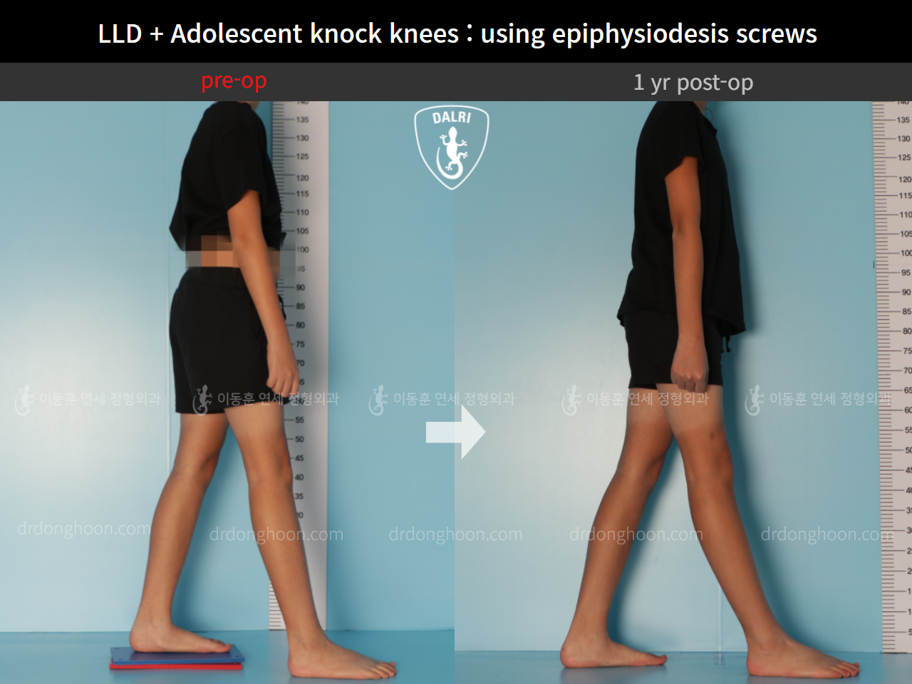 Before and after paediatric & adolescent knock knees, case 9186061, image 8, Dr. Donghoon institute (DALRI)