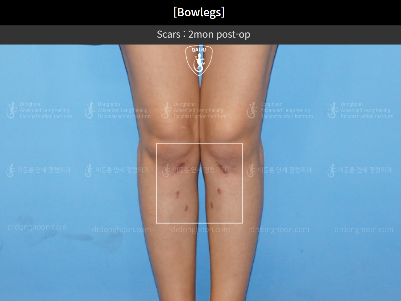 Before and after adult bowlegs, case 4310993, image 8, Dr. Donghoon institute (DALRI)